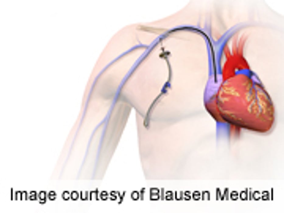 Type of Vascular Access Linked to Outcomes in Hemodialysis