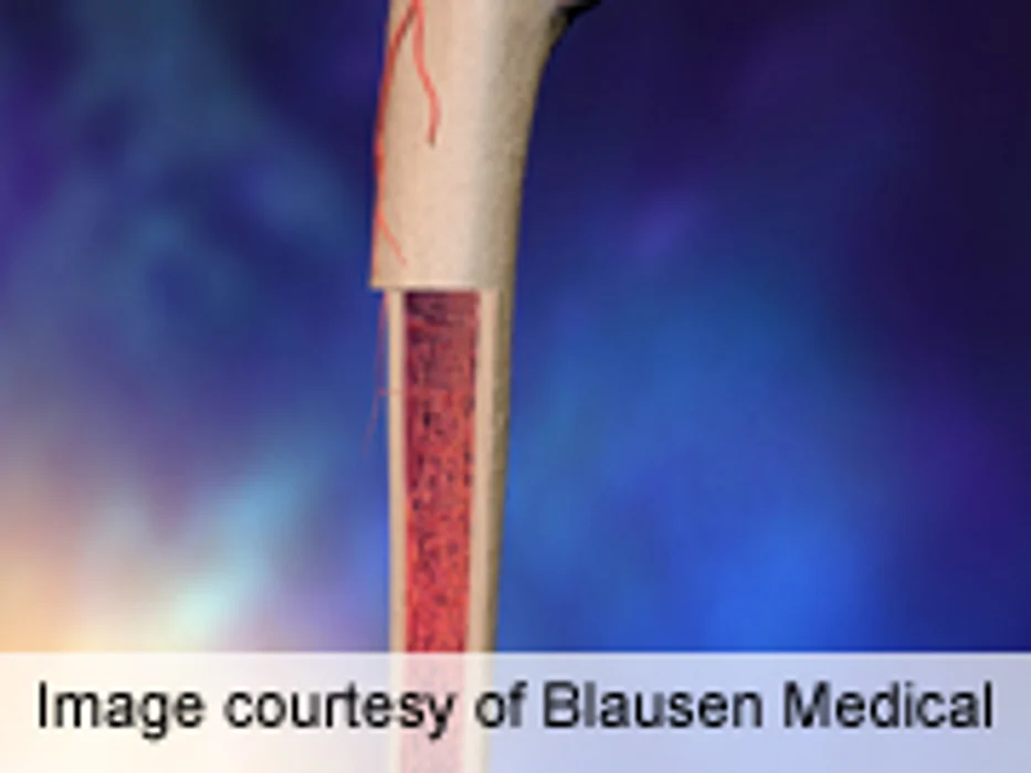 Alkylating Agent Linked to Therapy-Related Leukemia