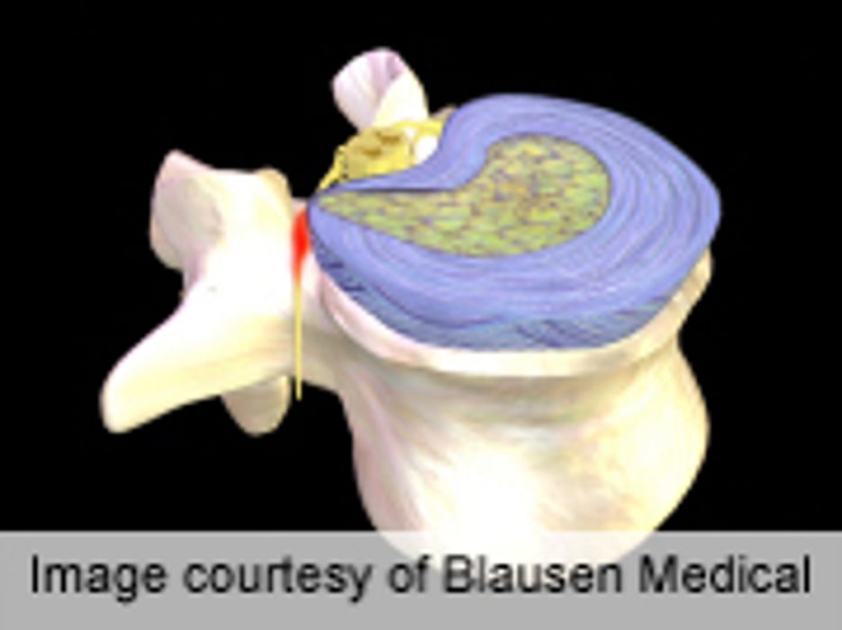 Re-Op Rates ID'd for Herniated Intervertebral Disc Disease
