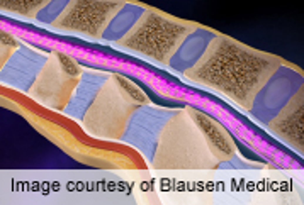 'Milestone' Therapy Produces Leg Movement in Paraplegics