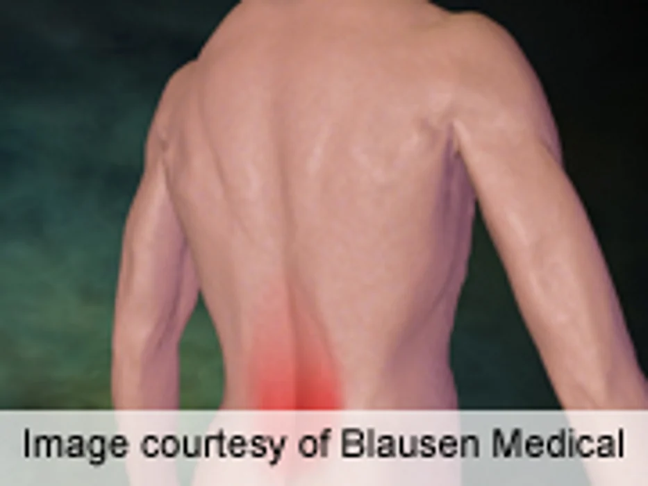 Workers' Compensation Data Captures Back Pain Experience