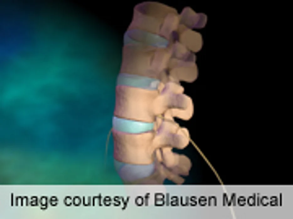 Improved Driving Reaction Times After Lumbar Disc Sx