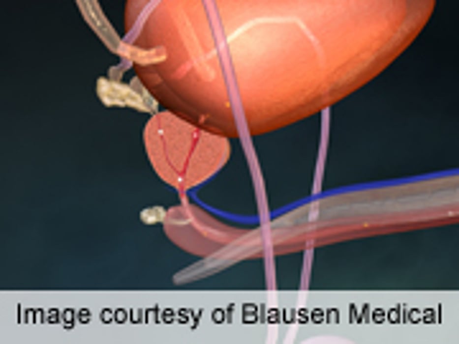 Tadalafil Not Helpful for ED in Prostate CA Post-Radiotherapy