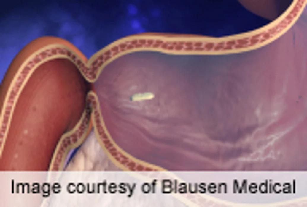 Video Capsule Accurately Detects Intestinal Blood