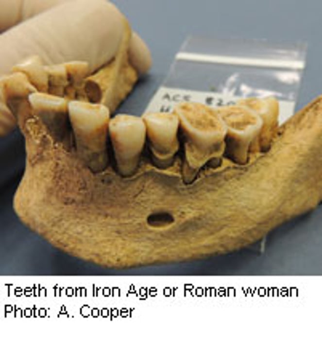 Human Teeth Healthier in the Stone Age Than Today: Study