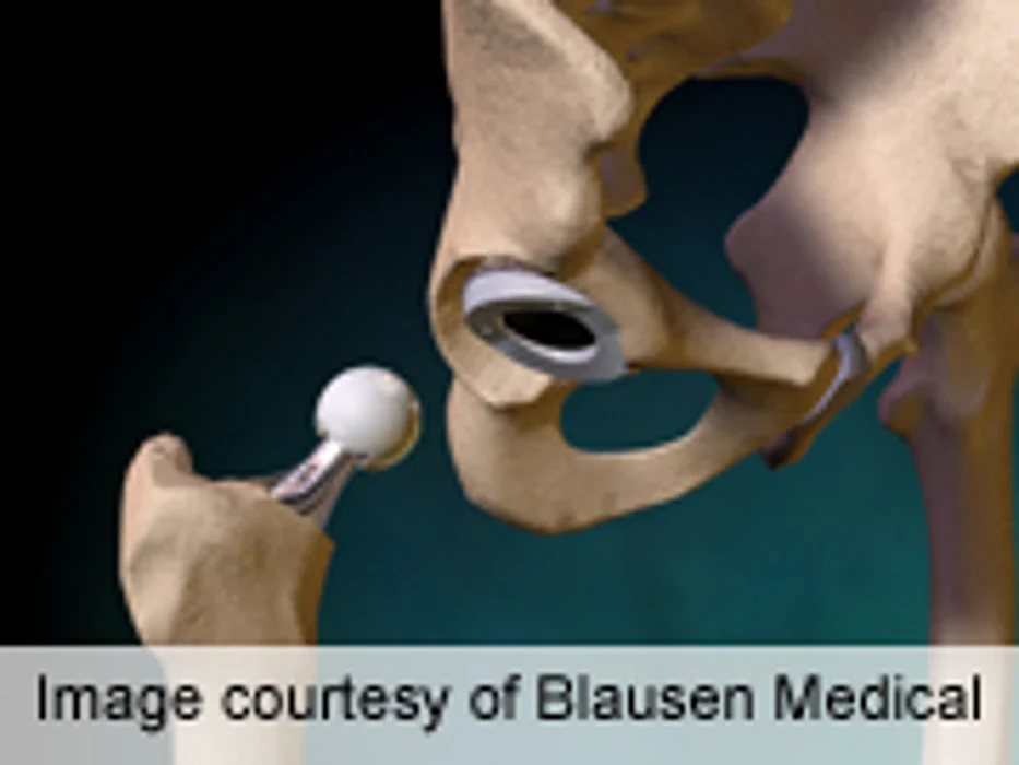 Higher Risk of Hip Implant Failure for Women Than Men