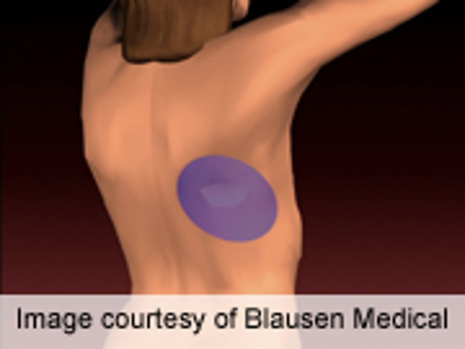 Breast Reconstruction Using Women's Own Tissue Appears Safe: Study