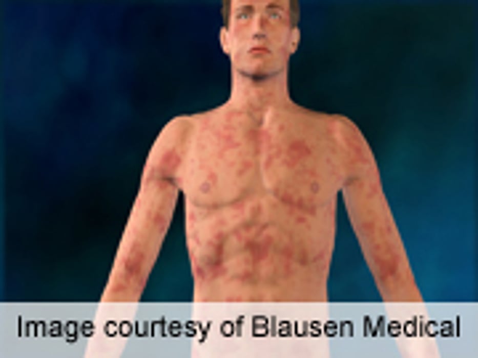 AAAAI: Omalizumab Treatment Effective for Urticaria