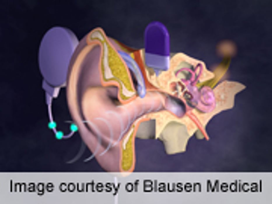 Cochlear Implantation Improves Hearing in Ménière's Disease