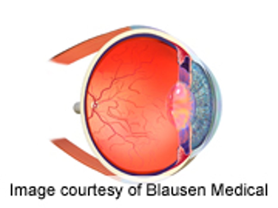 Ocular Complications Common After Pediatric HSCT