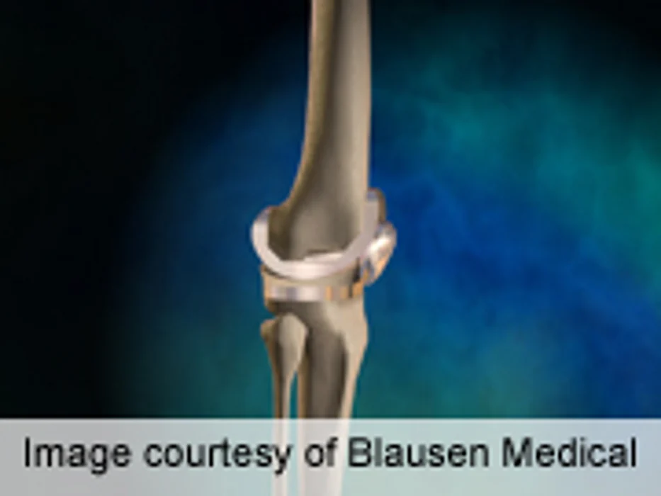 Glycemic Control Not Linked to Adverse Outcomes After TKA