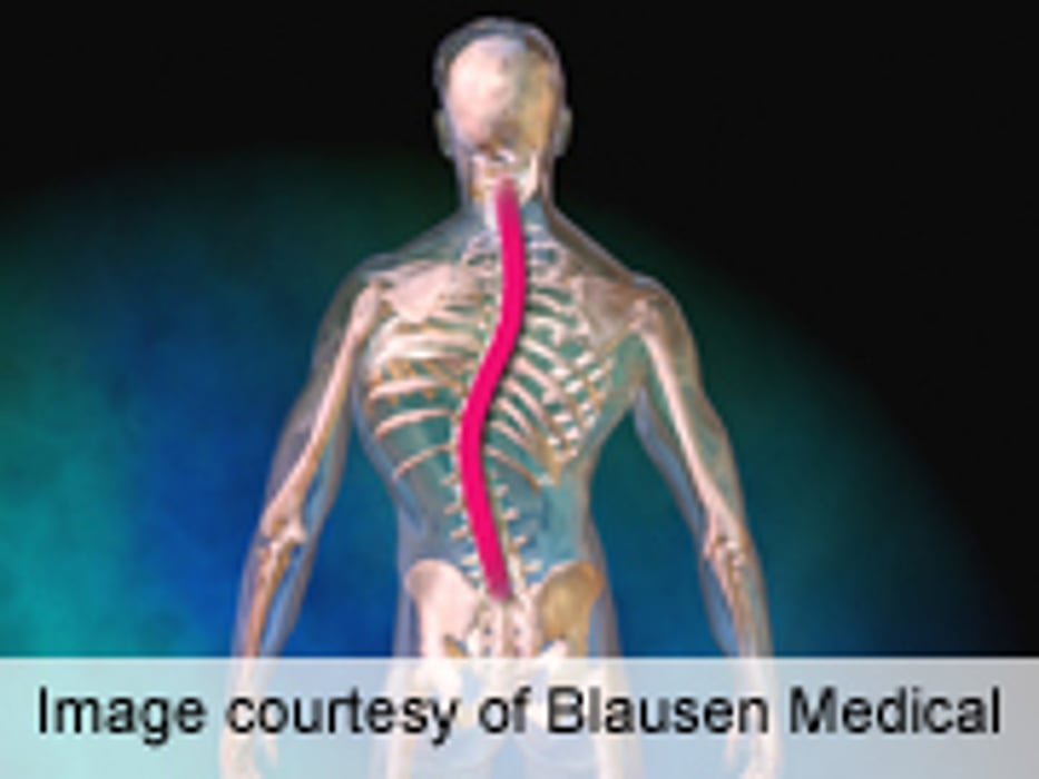 Ethnic, Socioeconomic Factors Impact Scoliosis Tx, Outcome