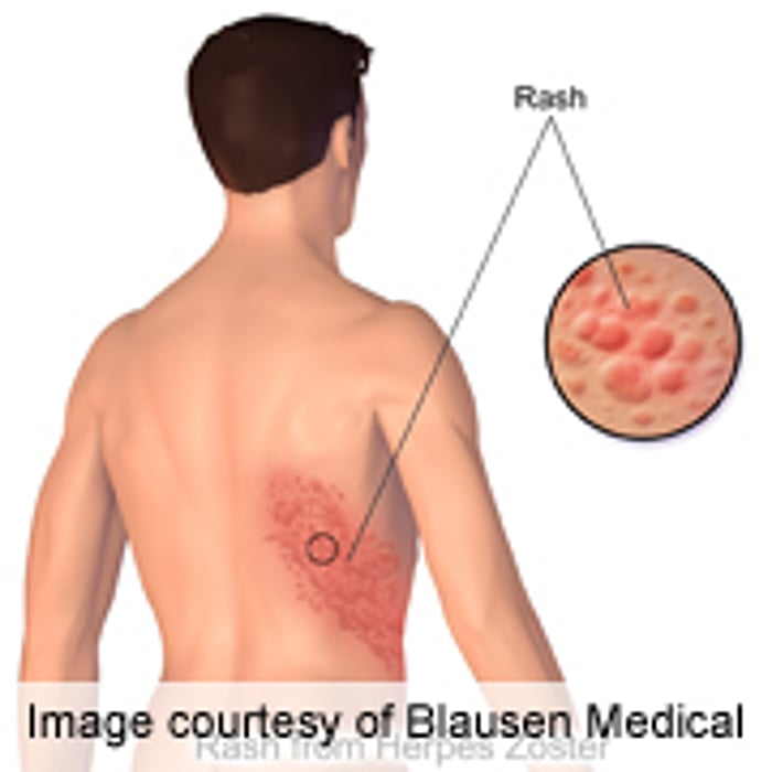 Varicella Vaccination Program Has Not Increased Herpes Zoster