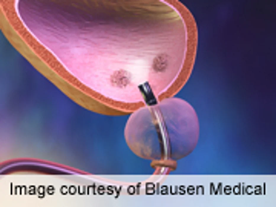 Smoking Plus Biomarker Panel IDs Bladder Cancer Prognosis