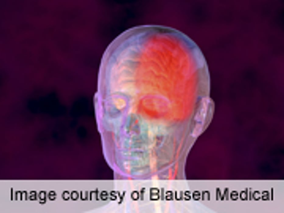 Drug Labeling Linked to Drug, Placebo Efficacy in Migraine