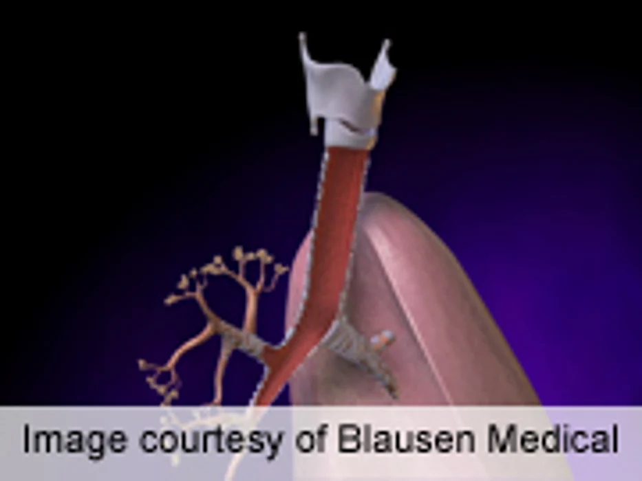 Decision Support Reduces Antibiotic Usage for Bronchitis