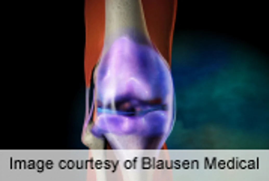 Ultrasound Findings Can Improve Classification of RA