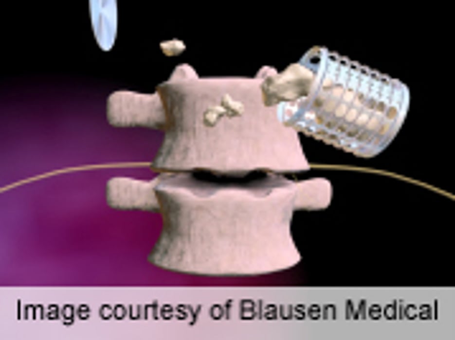 Back Pain Intensity Most Influential in Fusion Decision