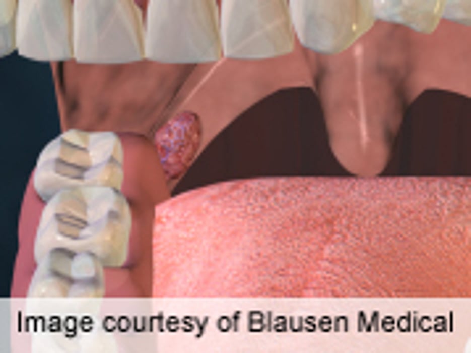 Tonsillectomy Benefits Adults With Recurrent Pharyngitis