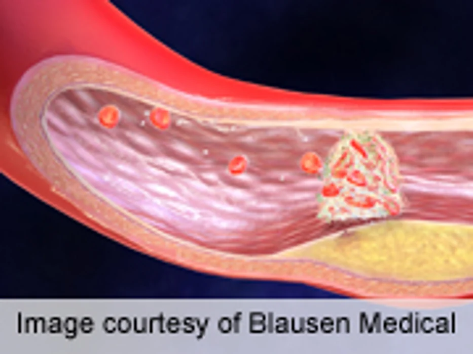 Chronic Pain Syndromes Are Common After Ischemic Stroke