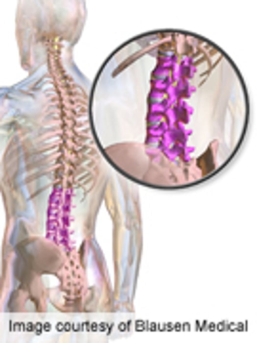 AAPM: Bone-Marrow Autografts May Help Reduce Low Back Pain