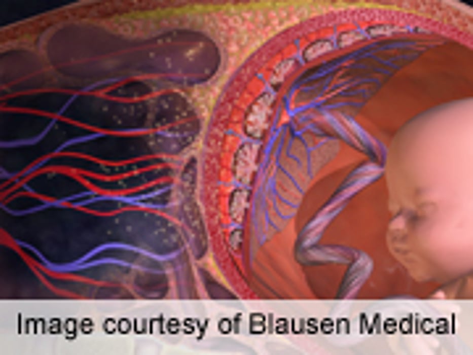 Low-Carb Diet Doesn't Improve Gestational Diabetes Outcomes