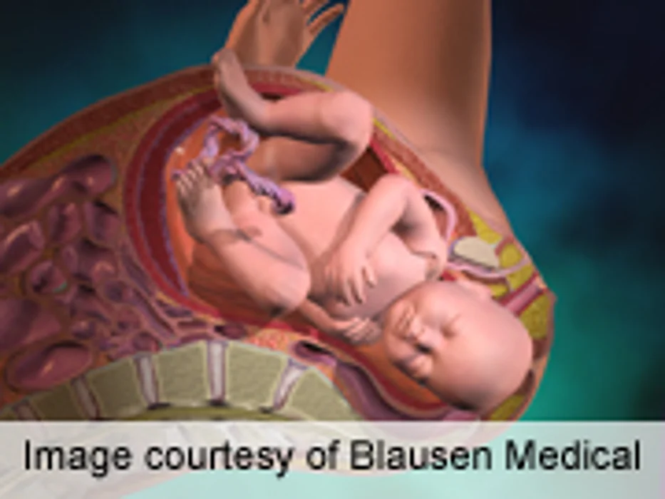 One-Year Survival Up for Critical Congenital Heart Defects