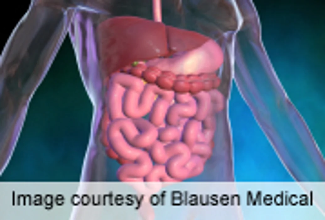 More Diverticulitis in Areas With Low-UV Light Exposure