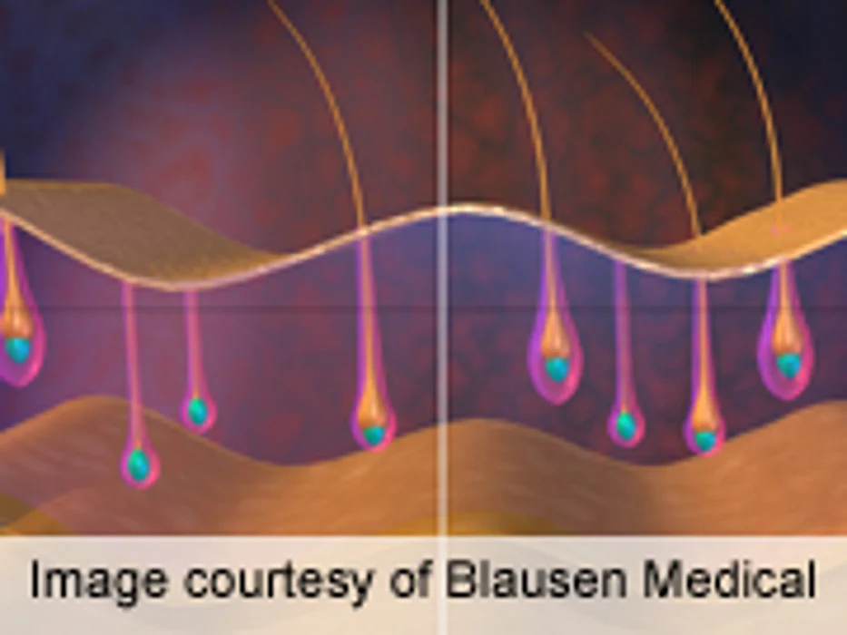 Hair Analysis Can Show Elevated Cortisol Levels