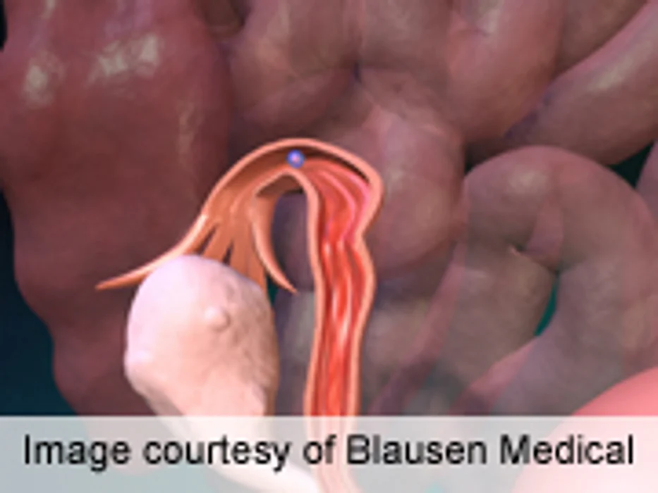 Review Looks at Best Modality for Diagnosing Ectopic Pregnancy