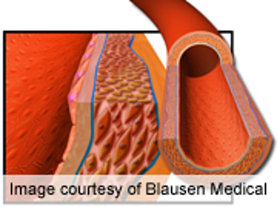 Statin Costs Impact Value of Coronary Artery Calcium Test