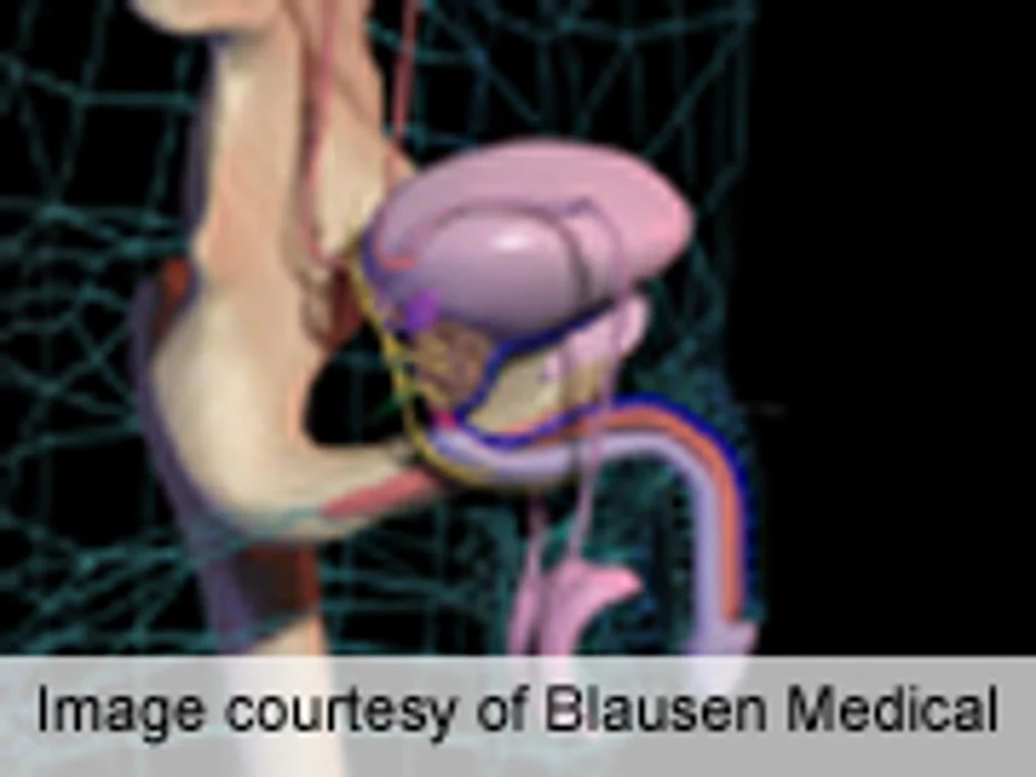 Collagenase Clostridium Histolyticum OK in Peyronie's