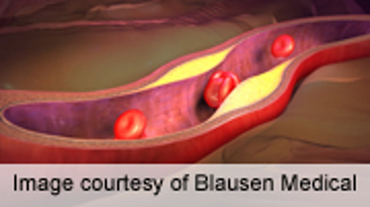 'Off-the-Shelf' Artificial Blood Vessels Show Promise