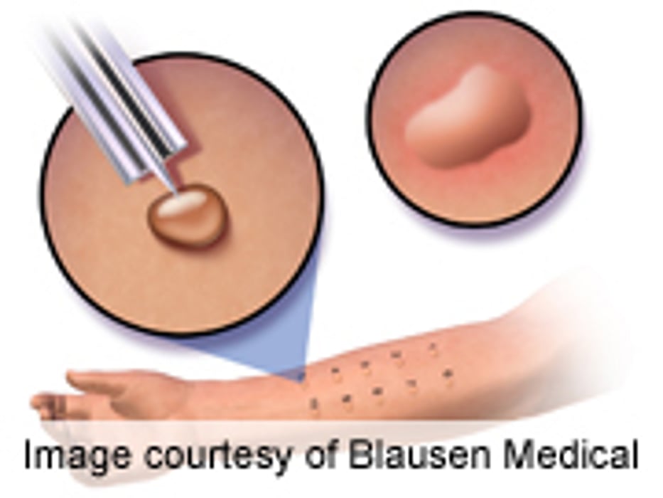 1997 to 2011 Saw Increase in Allergies Among U.S. Children