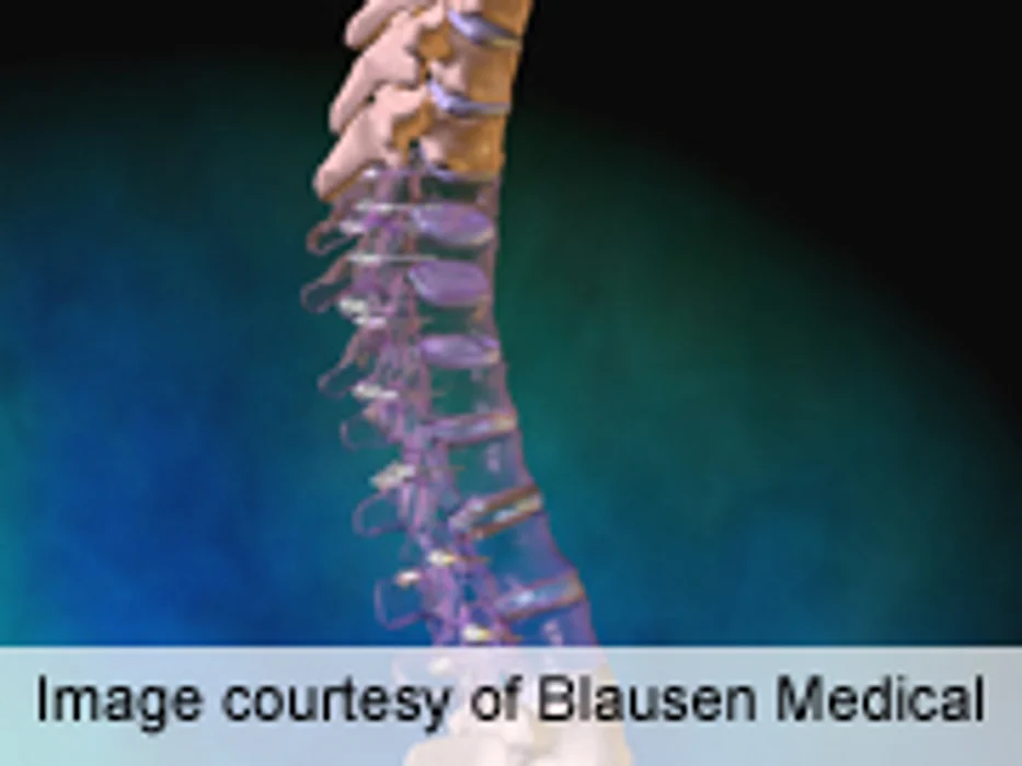 High Mortality, Morbidity With Early-Onset Scoliosis Surgery