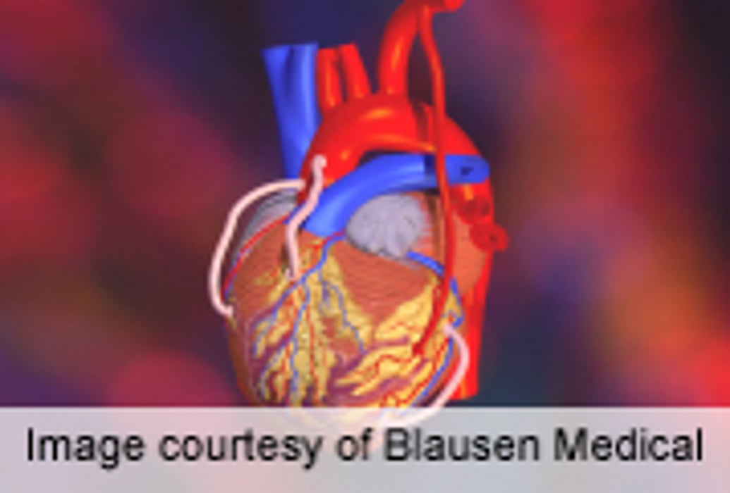 Patient Characteristics Impact CABG-PCI Treatment Effect