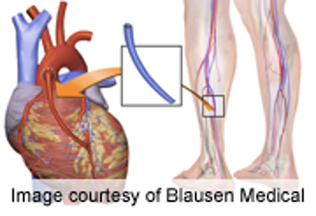 Heart Valve Replacement May Be Getting Safer for Seniors