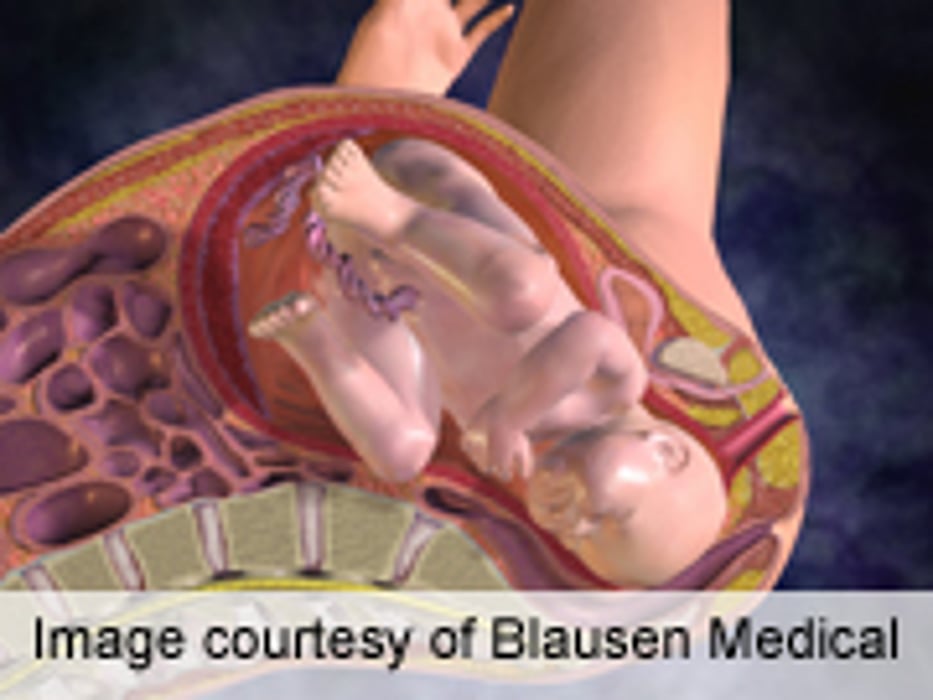 Study Redefines the 'Optimal Time for Delivery'