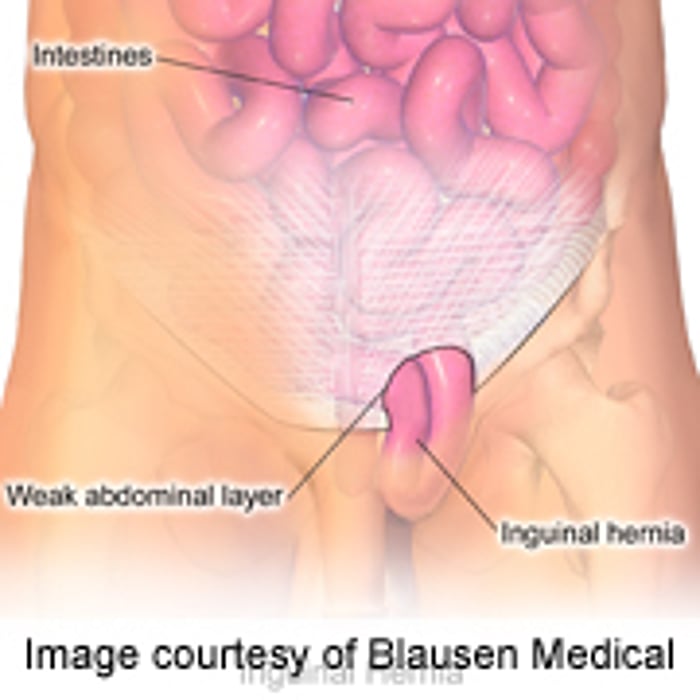 Laparoscopic Incisional Hernia Repair Is Effective Choice