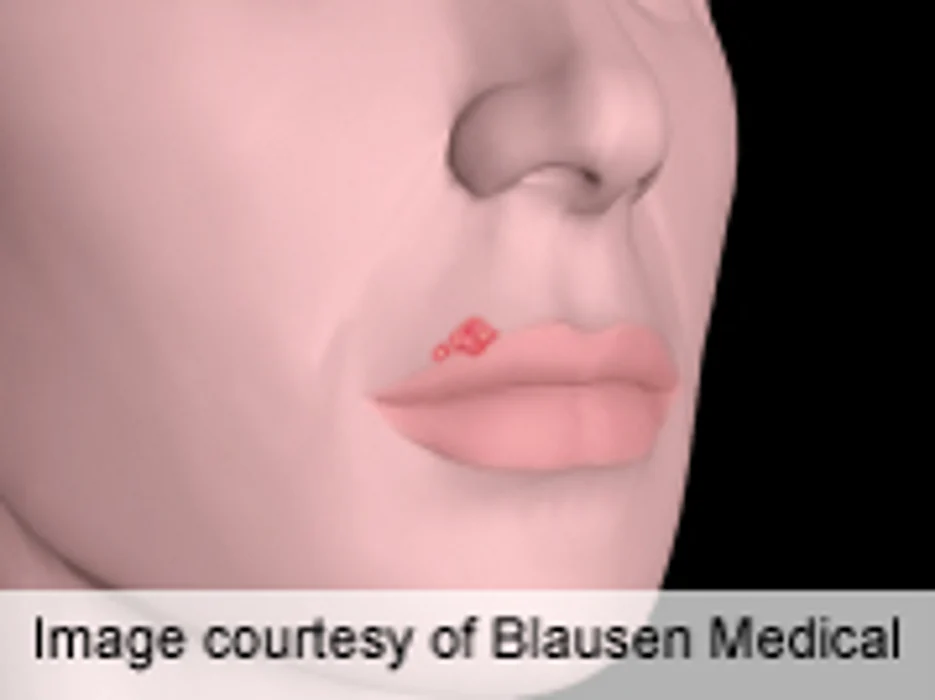 Frequent Cold Sores Tied to Genetic Mutation in Study