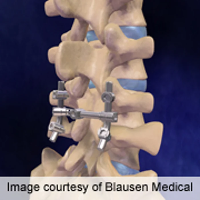 Low Vitamin D Levels Common Among Spinal Fusion Patients