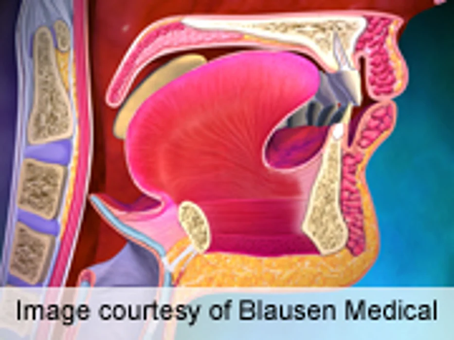 Review Explores HPV Link to Higher Risk of Esophageal Cancer