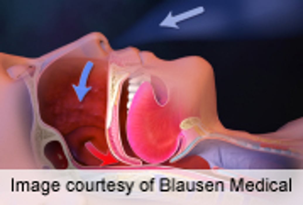Obstructive Sleep Apnea Ups Risk of Barrett's Esophagus