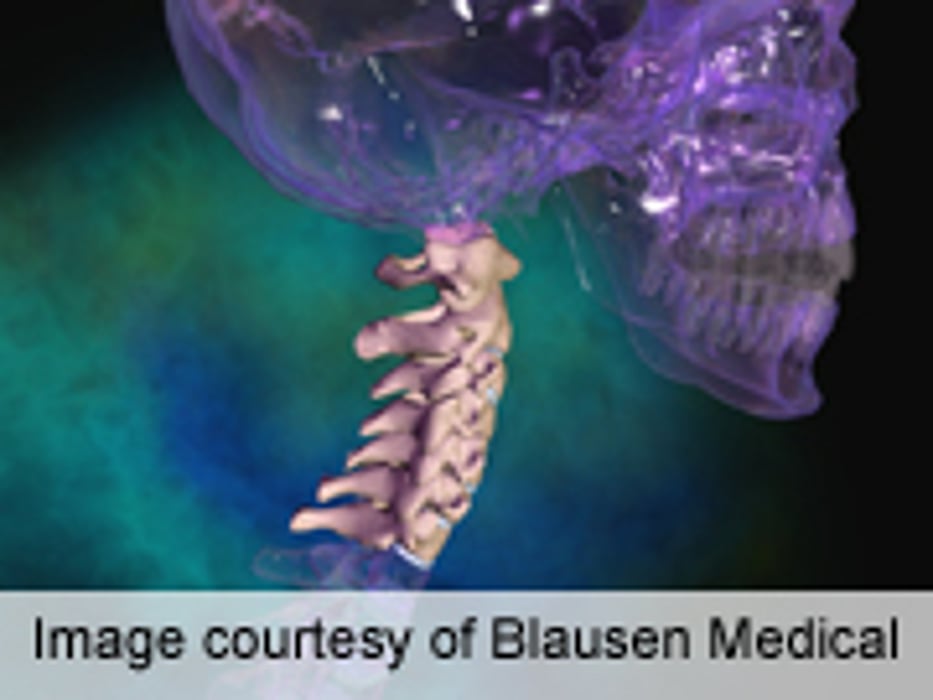 Comorbidities Affect Odontoid Fracture Survival in Elderly