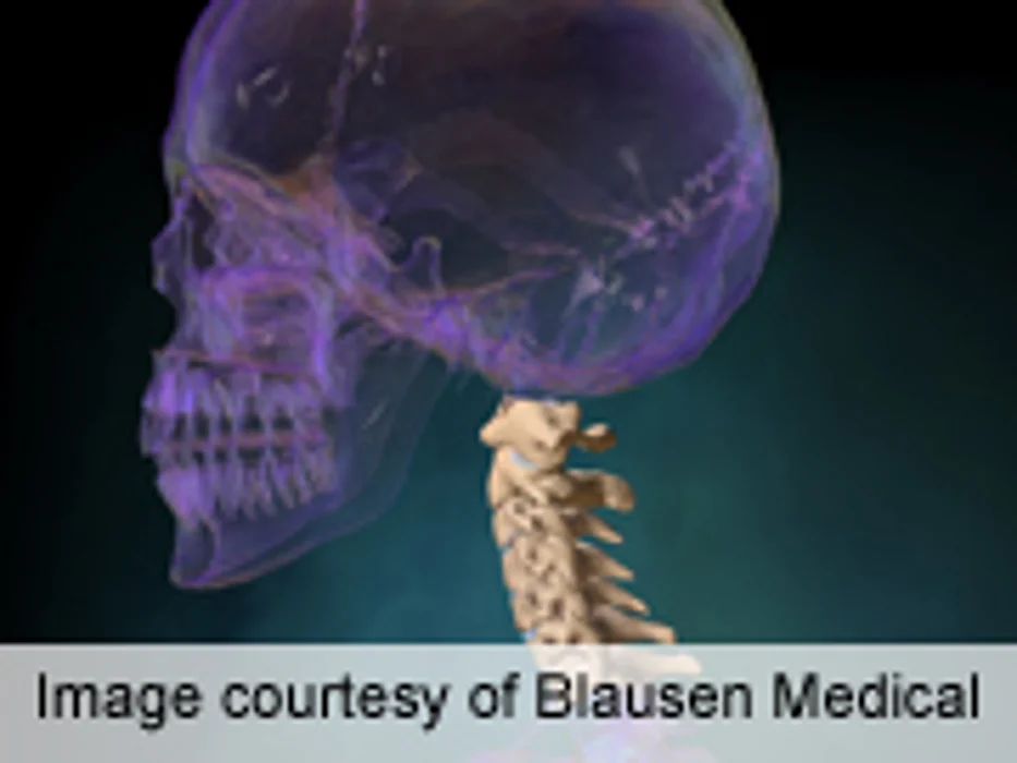 Diabetes Does Not Worsen Outcomes of Cervical Laminoplasty