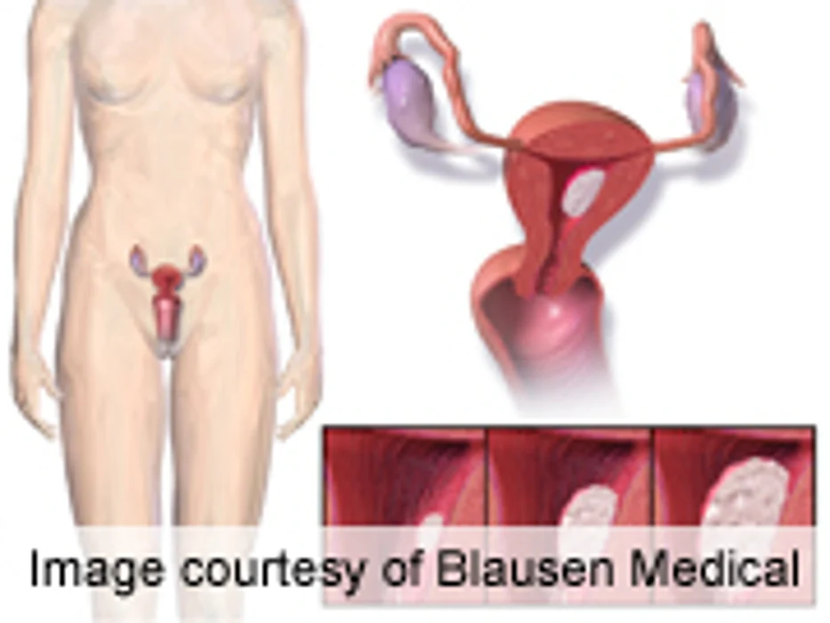Certain Bisphosphonates Tied to Lower Risk of Endometrial CA