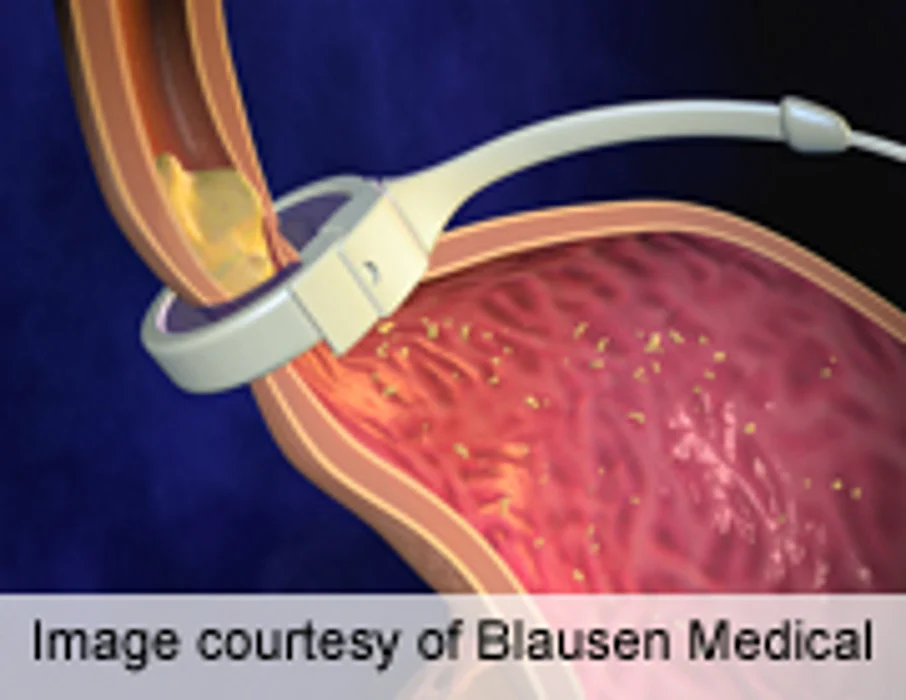 LAP-BAND Safe, Effective for Obese With BMI <40 kg/m²