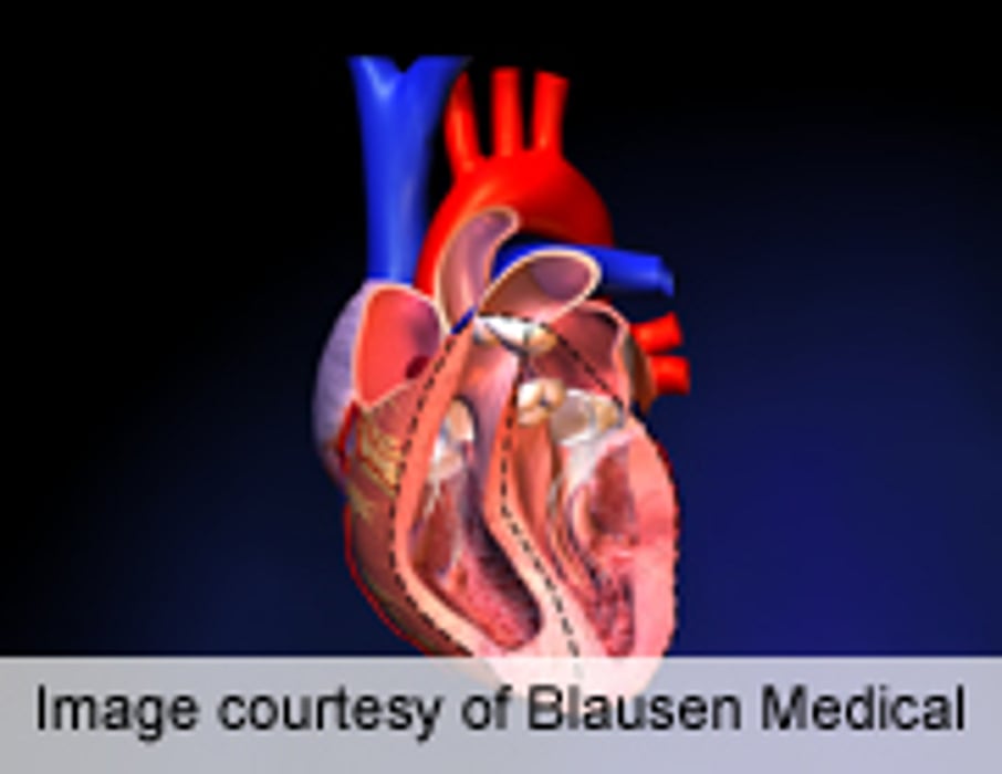 Patent Foramen Ovale Closure Cost-Effective Over Long Term
