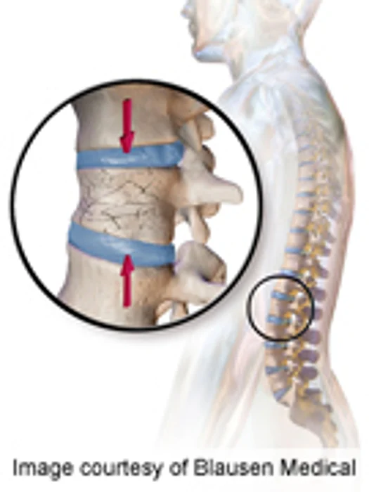 No Benefit of Vertebral Body Stenting Over Kyphoplasty