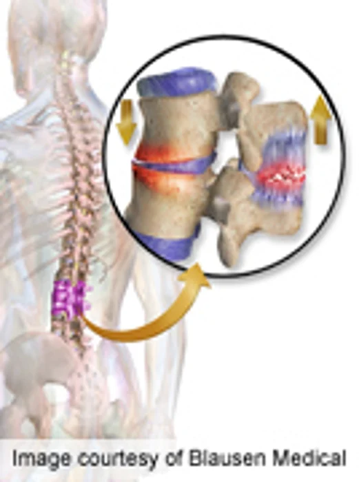 Little Evidence for Prediction Rules for Low Back Pain